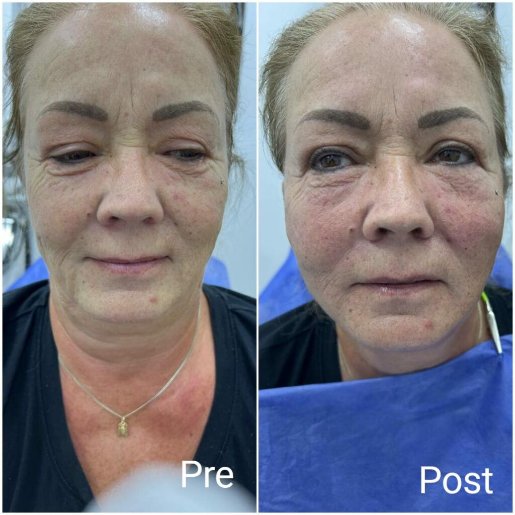 شد الوجه بالخيوط التجميلية